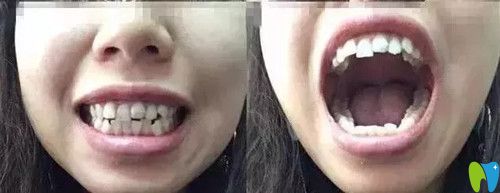 牙齒矯正前排列錯亂 牙齒矯正前排列錯亂