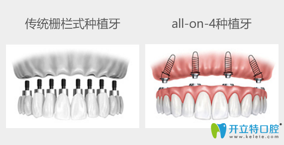 傳統(tǒng)種牙與all-on-4種植牙技術(shù)對(duì)比