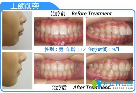 隱形正畸前后對比案例