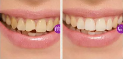門牙缺損怎么辦？看湛江珠江口腔做嵌體修復后真假牙難辨