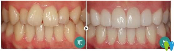 費麗敏主任牙齒不齊矯正案例 費麗敏主任牙齒不齊矯正案例
