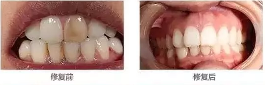 我們的牙齒為什么這么黃？新鄉(xiāng)貝特口腔教你來變白