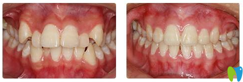 廣州拜博口腔牙齒矯正案例對(duì)比圖