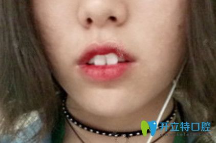 在九江奇洋口腔做了牙齒矯正，我擺脫了“兔牙妹”稱號(hào)