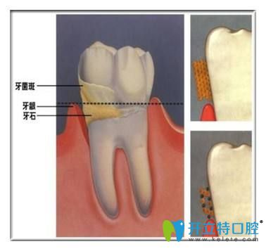 牙結(jié)石的危害你知道嗎？告別牙結(jié)石可以用這7種方法