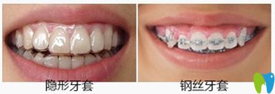 阜陽(yáng)貝得口腔牙齒矯正案例 阜陽(yáng)貝得口腔牙齒矯正案例