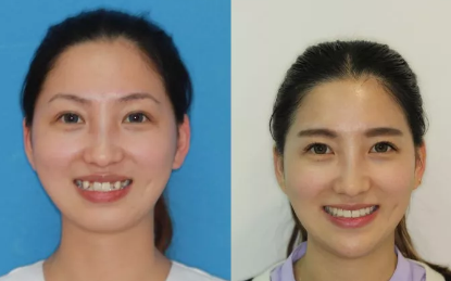 西安雁塔海濤口腔做的牙齒矯正手術(shù)，講講我有多痛苦