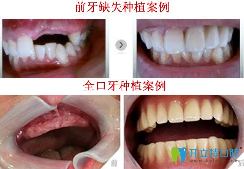 晉中潤芽口腔<!--<i data=20240703-sp></i>-->種植牙好嗎？看<!--<i data=20240703-sp></i>-->種植牙案例對比圖