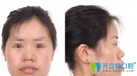 西安小白兔口腔做的牙齒矯正手術(shù)，忍受非一般的痛苦