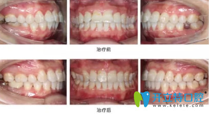 完全恢復(fù)之后我簡(jiǎn)直很開(kāi)心，牙齒就這么完美了