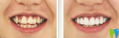 廈門宏沅膛杜海洲口腔正畸術(shù)前術(shù)后效果圖