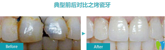 烤瓷牙前后對(duì)比