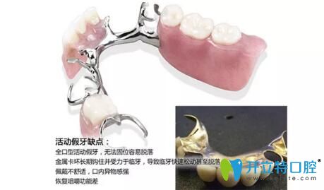 活動假牙的缺點介紹