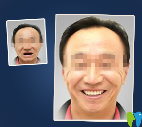 廈門宏沅膛口腔種植牙前后效果對(duì)比圖
