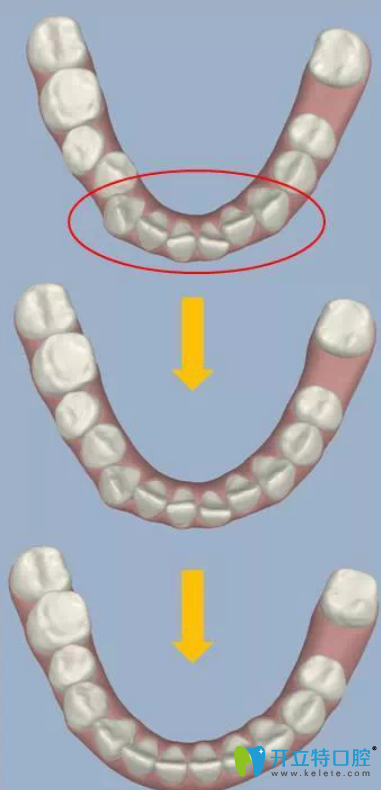 、醫(yī)師在3D數(shù)碼模型上模擬矯正療程