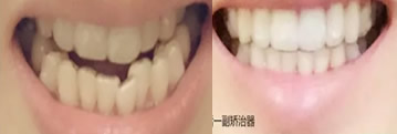 牙齒矯正要多久？90后美女用10個(gè)月完成牙齒正畸的真實(shí)經(jīng)歷