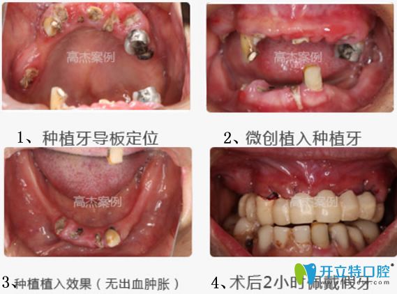 <!--<i data=20240703-sp></i>-->齒科上半口牙缺失患者修復(fù)案例