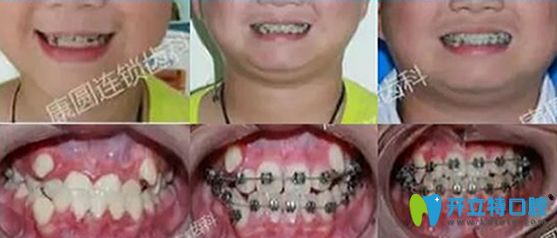 牙齒排齊需要多久？廣州康圓口腔90天排齊法案例來回答