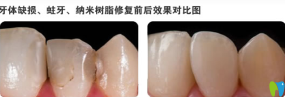 拜博口腔納米樹脂補牙修復牙治療前后對比照片