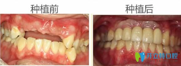東莞固德周毅院長全口牙缺失種植前后對比效果