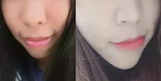 深圳牙齒矯正哪家好？看河山齒科齙牙妹正畸案例及對比圖