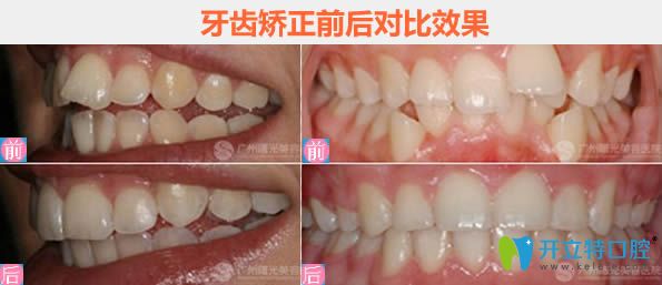 廣州曙光牙齒排列不齊及牙齒擁擠矯正對比圖