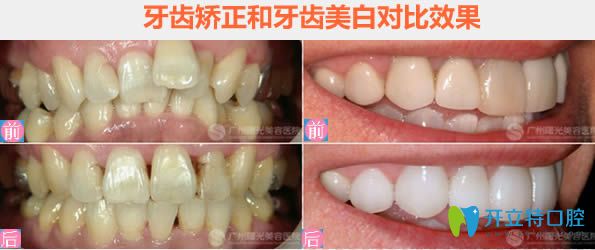 廣州曙光口腔李錦鴻牙齒擁擠及牙齒美白前后對比效果