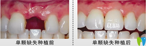 北京嘉和口腔郝國瑋醫(yī)生種植牙前后效果對比圖