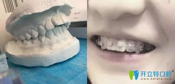 在康貝佳口腔做牙齒正畸取牙模初戴牙套