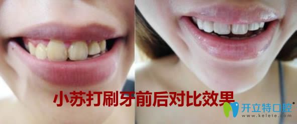 小蘇打刷牙后的前后對比效果