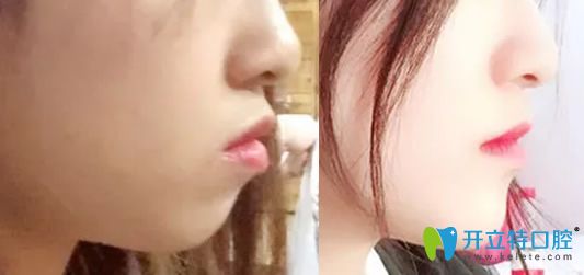 牙齒矯正能改變臉行嗎？看佳美口腔牙齒矯正前后對(duì)比照片知