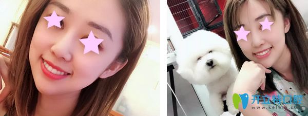 惠州麥芽口腔隱形矯正牙齒一年后效果