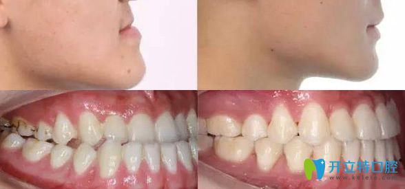 維樂口腔牙齒矯正前后效果對比