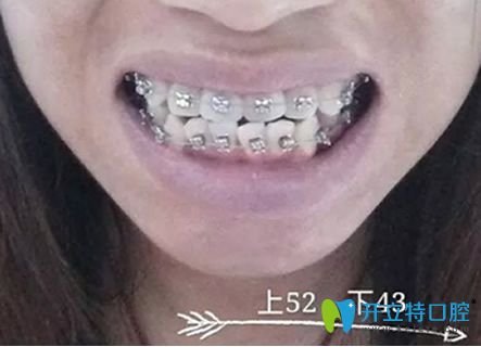 淮安牙知道口腔牙齒正畸后1個(gè)多月照