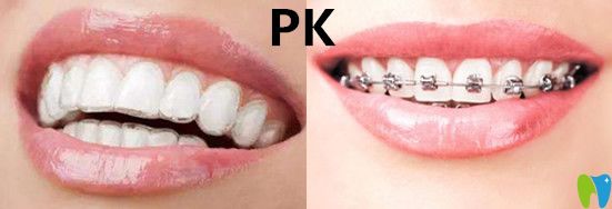隱形矯正VS傳統(tǒng)牙套哪種效果？有什么區(qū)別呢？