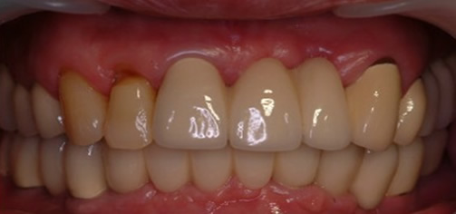 ?65歲王大媽多顆牙缺失在北京永康口腔種植牙齒后心得體會(huì)