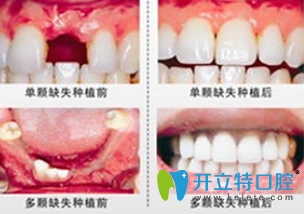 鄭州精益口腔李瑞萍院長(zhǎng)種植牙前后對(duì)比圖