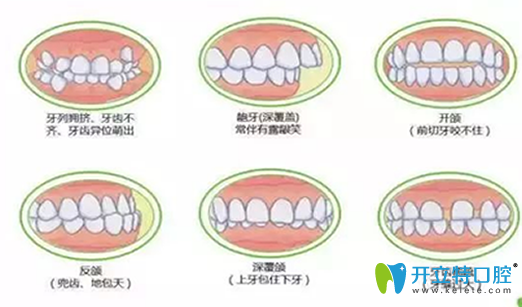 深度揭秘：在做牙齒矯正之前，你不得不了解的17個(gè)問題