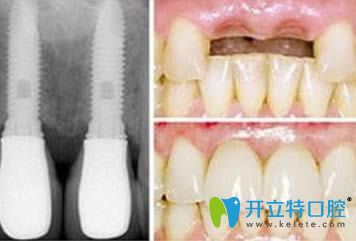 成都格林口腔<!--<i data=20240703-sp></i>-->忠院長(zhǎng)種植牙案例圖