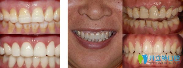拜博口腔牙齒美白及牙周治療效果