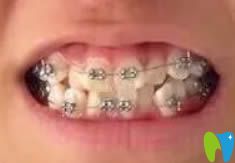 沈陽(yáng)博得口腔鎮(zhèn)診所金屬托槽牙齒矯正圖
