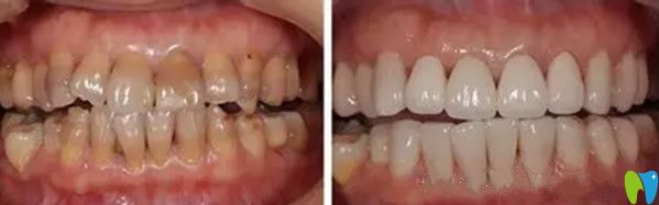 齒康口腔氟斑牙美白修復(fù)效果