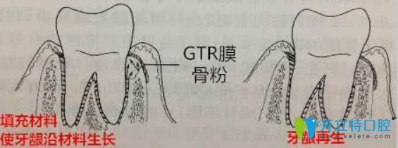 開立特牙齦再生術(shù)圖解
