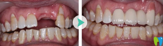 福州維樂口腔張俊偉怎么樣？看牙齒種植案例效果