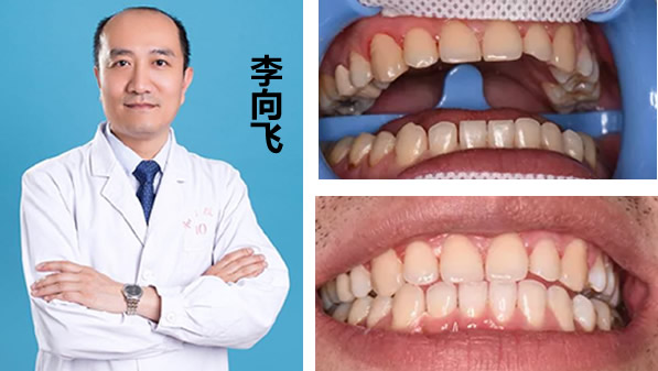 冷光美白牙齒多少錢 李向飛口腔680元的價(jià)格你確定要錯(cuò)過(guò)嗎