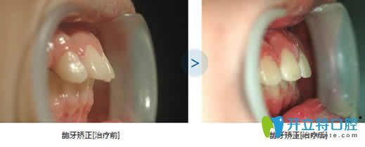 泉州維樂(lè)口腔齙牙矯正前后效果對(duì)比圖