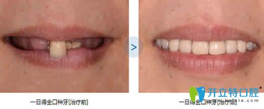 泉州維樂(lè)口腔全口種植牙前后對(duì)比圖