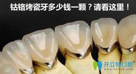鈷鉻合金烤瓷牙多少錢(qián)一顆?看了價(jià)格表就知道500元貴不貴了