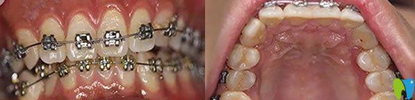 牙齒矯正三個(gè)月的恢復(fù)效果圖