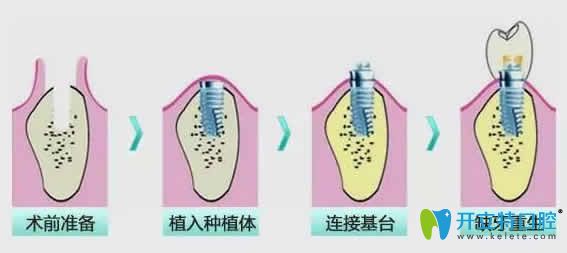 即刻種植牙步驟